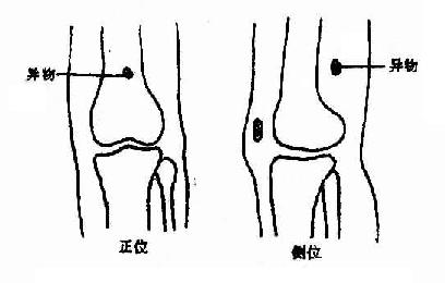 异物定位,正位及侧位摄片法