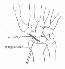 第一掌骨基部骨折