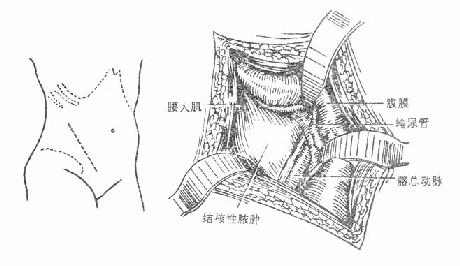 骶髂关节结核病灶清除术,前显露法