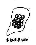 高分化鳞癌与鳞状化生, 核异质细胞鉴别示意图