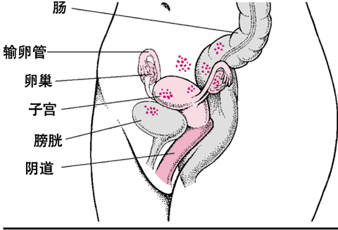子宫内膜异位症:错位的组织