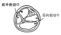 小腿两个皮肤切口,切开四个筋膜间室减压示意图
