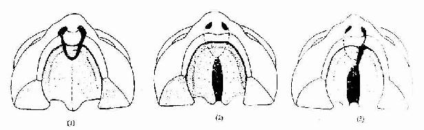 腭裂