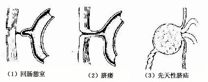 肠管先天性畸形