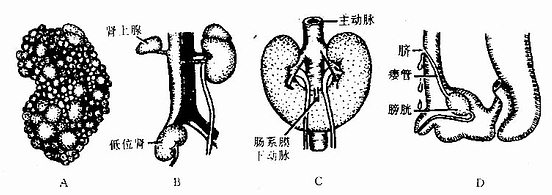 泌尿系统先天性畸形