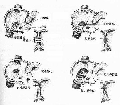 房间隔缺损(右面观)